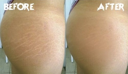 Cách để chữa hết vết rạn da cho bạn 